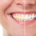 Effective Teeth Whitening Techniques for a Brighter Smile