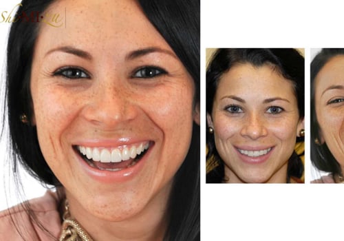 Can Dental Veneers be Used to Repair Chipped or Damaged Teeth?